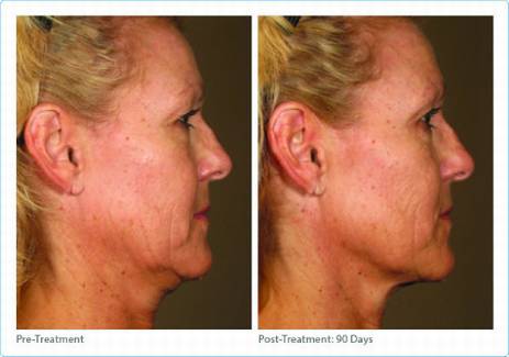 Ultherapy skin tightening Dr Varano Washington DC & Virginia Ultherapy skin tightening Dr Varano Washington DC & Virginia